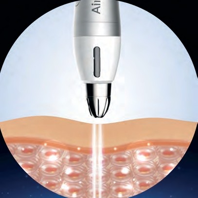 Air Infusion Behandlung