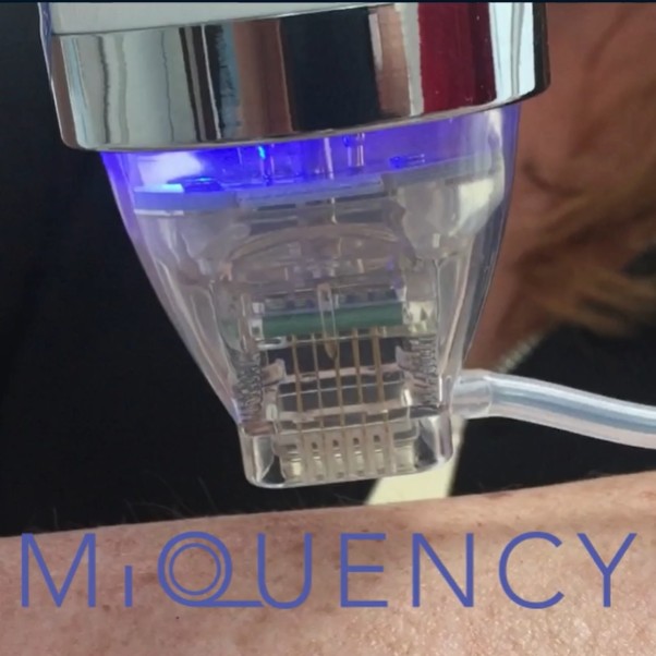 Radiofrequenz-Needling MiQuenzy Behandlung