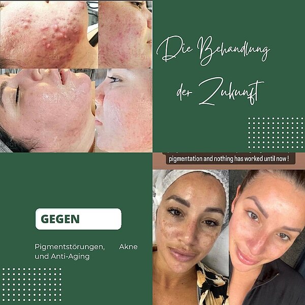 Bio Microneedling 2 Kosmetik Wolfsteiner