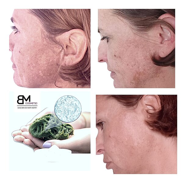 Bio Microneedling Kosmetik Wolfsteiner